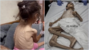 Menyedihkan Melihat Anak-anak Gaza, Tubuh Tinggal Tulang Karena Kelaparan