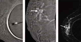 Study Suggests Contrast-enhanced Mammography As An Alternative To Breast MRI For Imaging Lobular Carcinoma