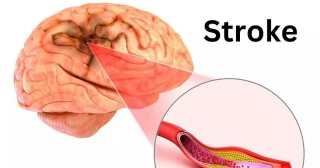 New Study Reveals Uric Acid's Role In Stroke Recovery: Implications For Treatment