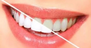 Enlightening Smiles: Review Explores The Current Status And Future Prospects Of Tooth Whitening