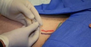 Ultrasound-guided Axillary Artery Catheter Placement: Enhancing Care In Critically Ill Patients