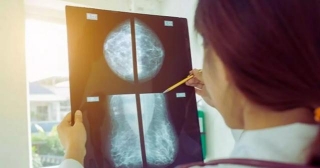 Breast Arterial Calcification On Mammography Could Identify Women At High Risk Of CVD In Future: Study