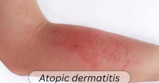 Dupilumab Treatment May Improve Work Productivity In Patients With Atopic Dermatitis: Study