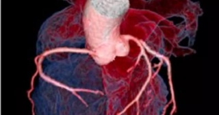 TyG-BMI Index Linearly Associated With Degree Of Complex Coronary Artery Disease In Female ACS Patients: Study
