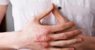 Sulfur Cream Matches Triamcinolone In Treating Hand Eczema: Study