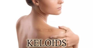 Combination Therapy Of Bleomycin And Triamcinolone Promising For Keloid Treatment: Study