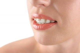Dental Implants Las Vegas: Cost & Shine Bright With Boca!