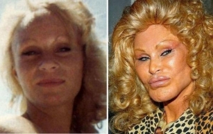 «They Passed Through Their Future: 😱😩Celebrities Who Were Unable To Reverse The Effects Of Plastic Surgery!»