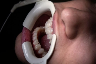 Understanding Whitening Versus Bleaching In Dental Care