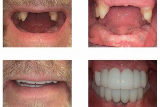 Smile Makeover With Stephen L.