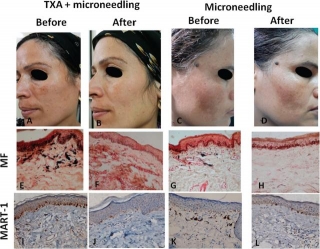 Unlocking The Secret To Melasma Management: Microneedling Meets Topical Tranexamic Acid