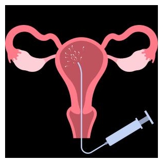 What Is Intrauterine Insemination (IUI) Treatment? And How Does It Works?