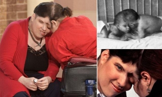 SAD: World's Oldest Conjoined Twins Pass Away At Age 62.