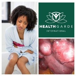 How To Shrink Or Remove Fibroid Without Surgery By Healthgarde