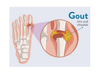 All You Need To Know About Gout: Healthgarde Nutritional And Herbal Remedy For Gout