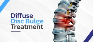 Diffuse Disc Bulge Treatment