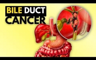 Bile Duct Cancer Hitting Much Youger People. COVID or Vaccines to Blame?