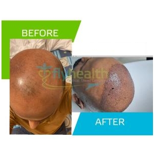 A Body Hair Transplant Success Story: From Bald To Beautiful