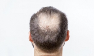 Which Vitamin Deficiency Causes Hair Loss