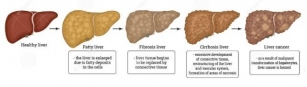 Fatty Liver Disease Epidemic