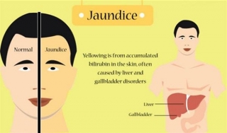 Jaundice Unveiled: Causes And Symptoms