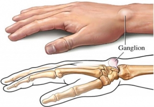 Understanding Ganglion Cysts: Symptoms, Causes, And Treatment Options