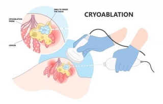 Cooling For Health: Cryoablation Explained