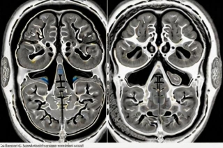 Cytotoxic Cerebral Edema: Cell Damage In The Brain