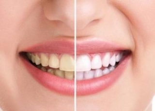 Gain Confidence In Your Smile! Unveiling The Reality Behind Yellow Teeth