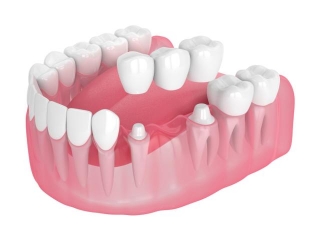How Dental Bridges Improve Oral Health Across Ages