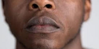 Comprehensive Guide To Darkness Of The Upper Lip: Causes, Treatments, And Treatment Options