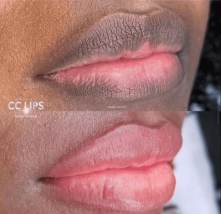 How To Remove Dark Upper Lip: Effective Solutions For