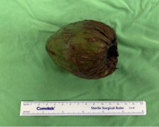 Man Ends Up With Coconut Stucked In His Bum After Risky S*xual Experiment Gone Wrong