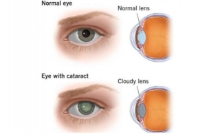 What Is The Standard Lens Used For Cataract Surgery?