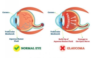 Glaucoma: Types, Symptoms & Treatment