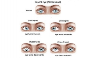 Squint Eye Surgery: Types, Causes, Treatment And Cost