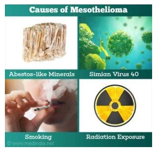 Mesothelioma Lawsuit Settlements:10 Things To Know