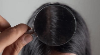 Navigating The Best Hair Loss Treatment In Mumbai: A Comprehensive Guide For 2024