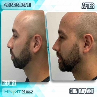 Enhance Your Profile: The Ultimate Guide To Chin Implants