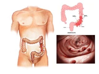 What Exactly Is Diverticulitis? Symptoms, Diagnosis And Treatment