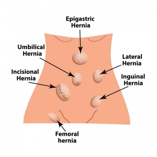 Comprehensive Guide To Hernia Treatment: Options, Recovery, And Prevention