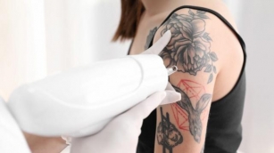 Discover How Long The Journey To Remove Tattoos Actually Takes