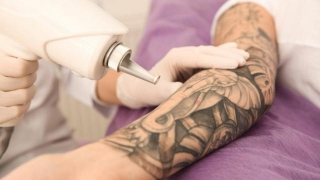 Simple Guide To Understanding Tattoo Removal Techniques