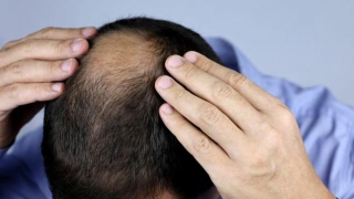 Addressing Hair Loss With Modern Medical Aesthetics