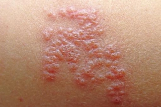 Pandemic And Costs Limited Use Of Shingles Vaccine