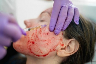 CDC Investigates Women Infected With H.I.V. After ‘Vampire Facials’