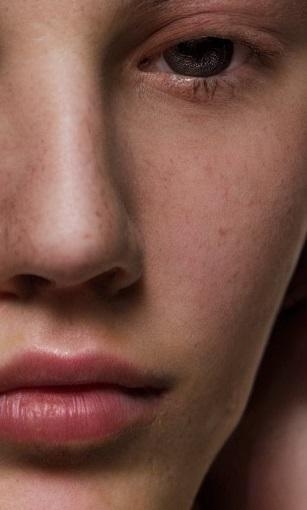 8 Secrets On How To Remove Acne Scars - Natural Medical