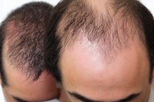 Selecting A Hair Loss Treatment - Natural Medical