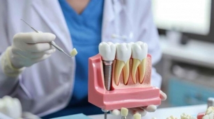 Unveiling The Pinnacle Of Dental Restoration: Exploring Dental Implants And Permanent Dentures