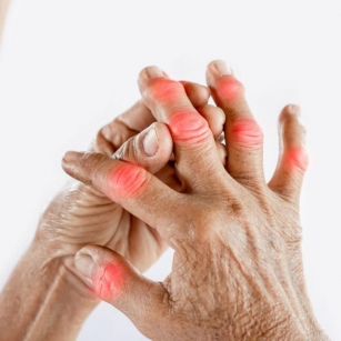 Rheumatoid Arthritis: What It Is, Symptoms, And Treatment